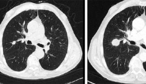 lungs